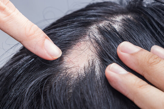 Hair Transplantation in Vizag