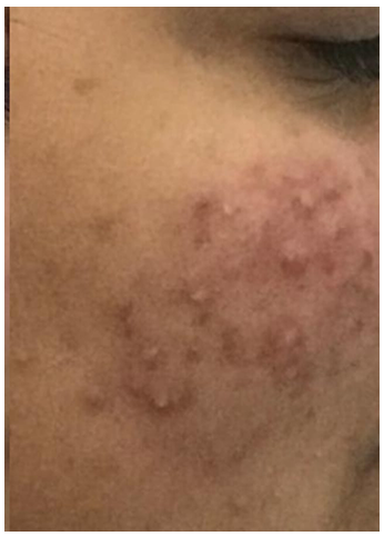 Acne-Control-before