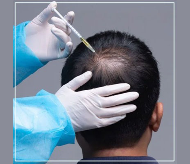 Hair Transplantation in Vizag