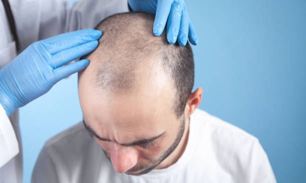 Hair Transplantation in Vizag