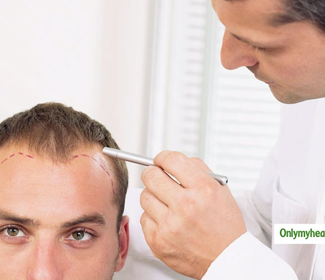 Hair Transplantation in Vizag